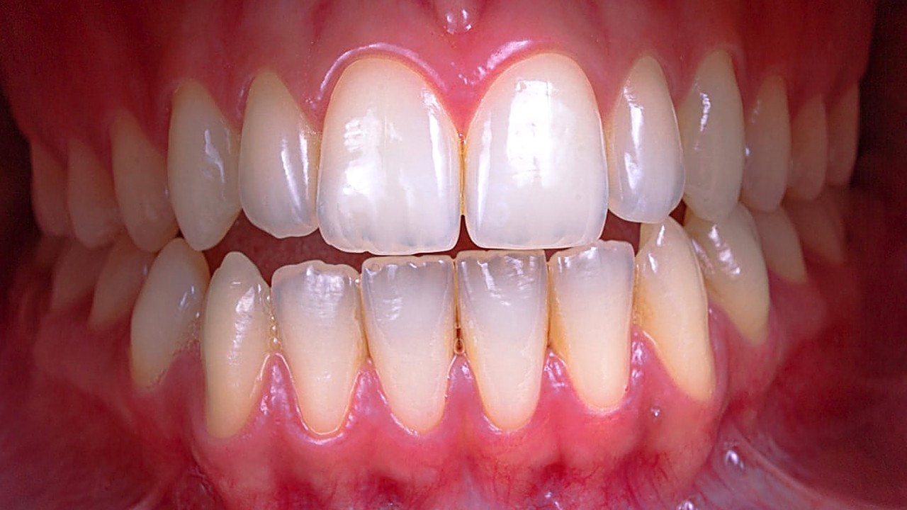 Stop gum pain after flossing with safe, easy steps. Learn why it happens and how to fix it fast without harm.