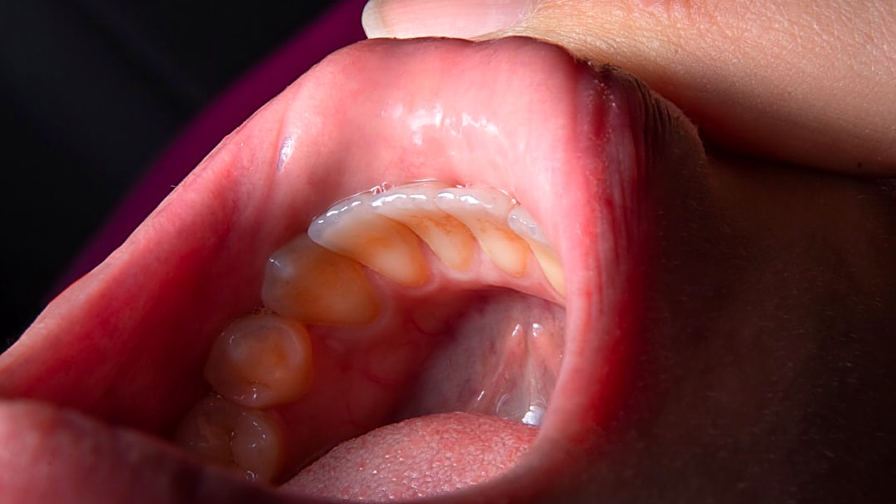 Learn how tobacco harms gums, the signs to watch for, and if stopping smoking can improve gum health. Practical tips…