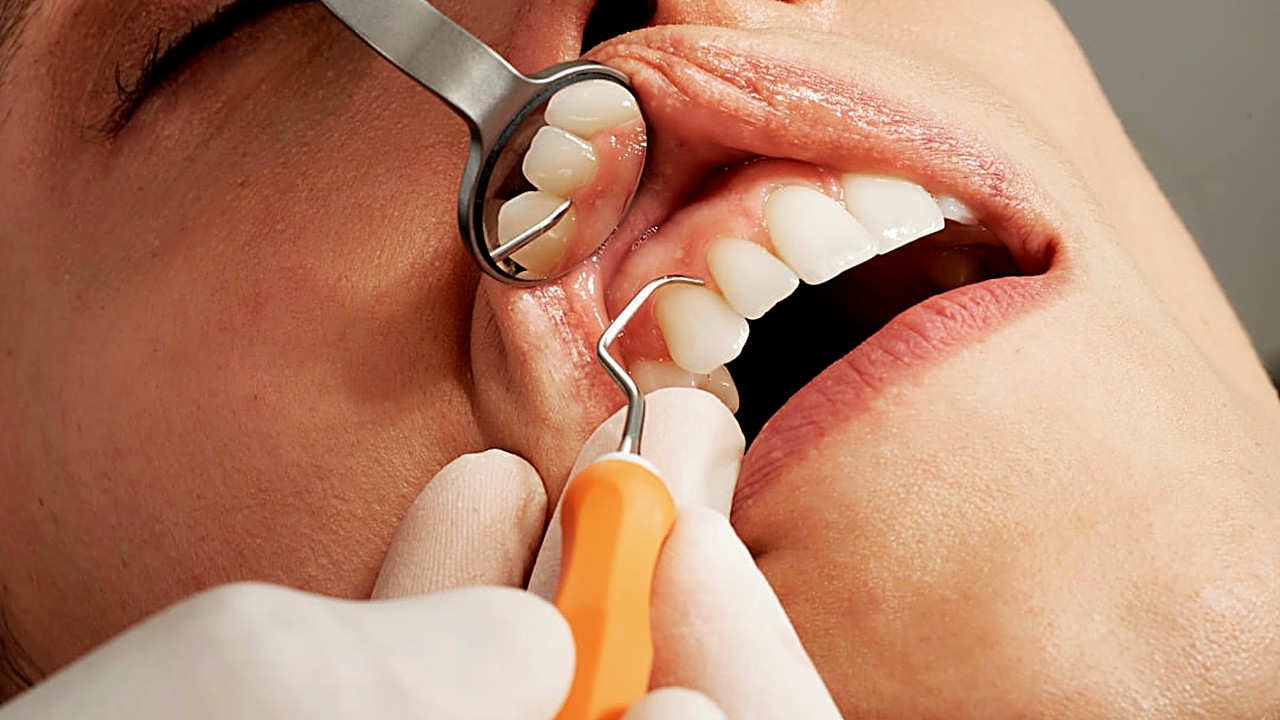Learn simple, practical ways to notice early gum recession at home. Follow step‑by‑step checks, understand common…