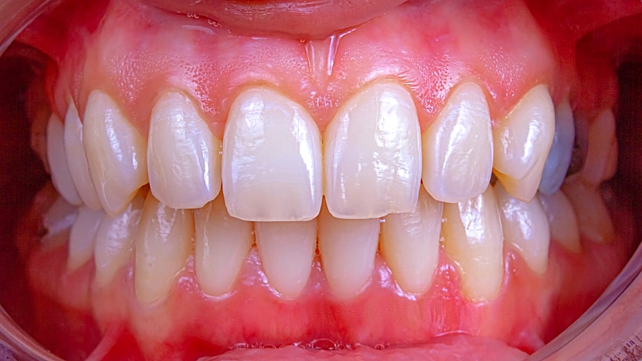 Learn simple ways to notice early gum disease signs at home, from bleeding gums to bad breath, and know when to see…