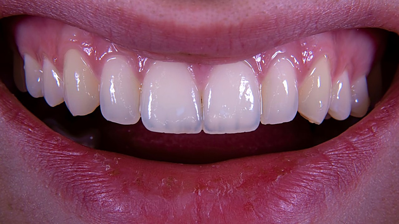 Learn if a simple salt water rinse can help early gum disease. Safe steps, limits, and when to see a dentist.