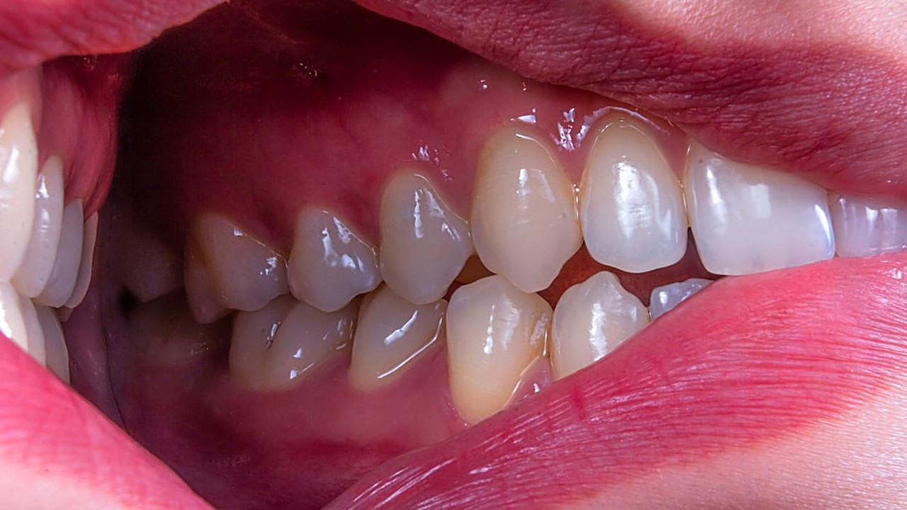 Learn why brushing too hard causes bleeding gums and simple ways to fix it with gentle care and the right tools.
