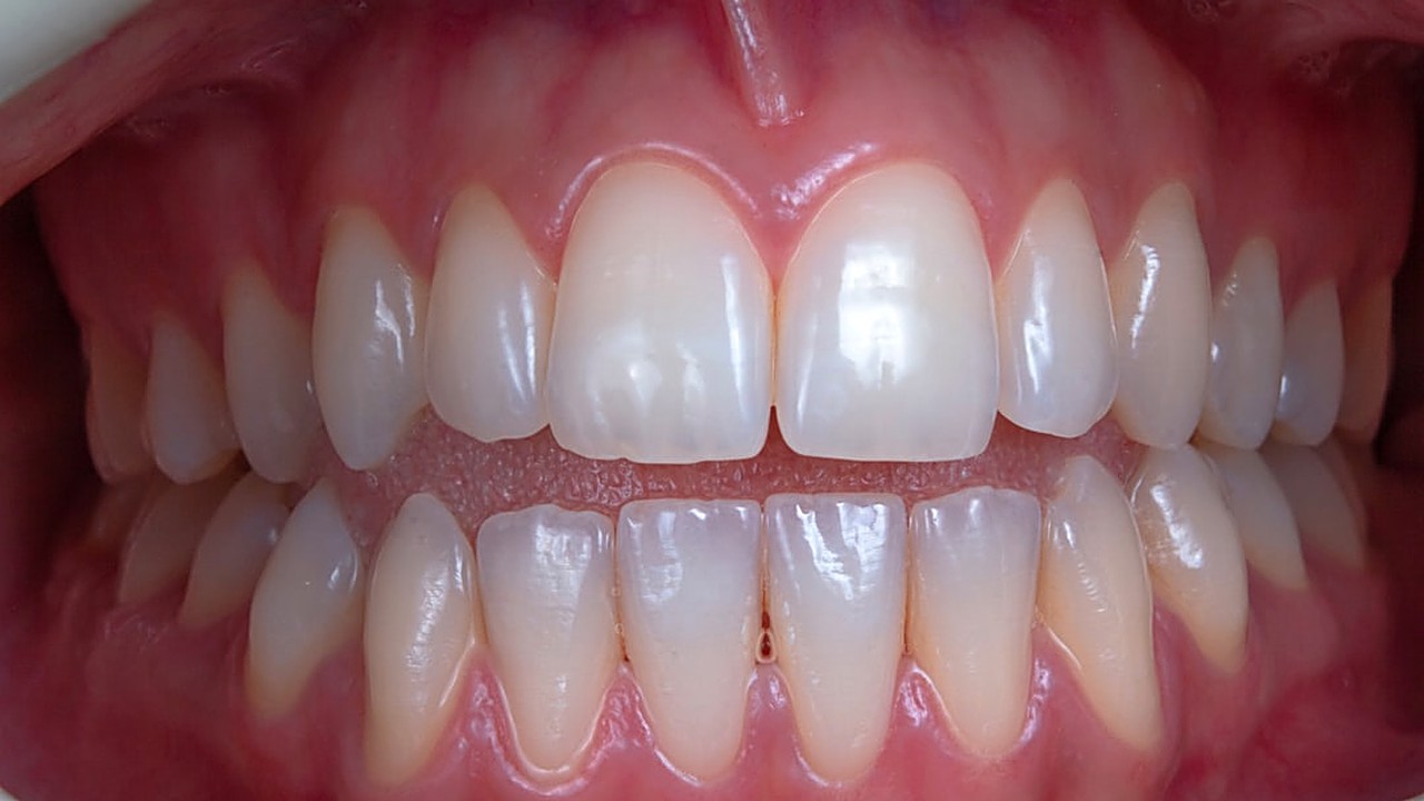 Learn why gums pull back and discover simple, natural habits to protect your smile. Practical tips for everyday care…